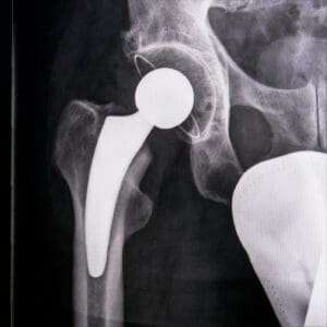 Разлика между коксартроза и остеопороза