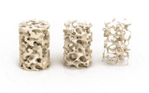 какво е сенилна остеопороза - рискове